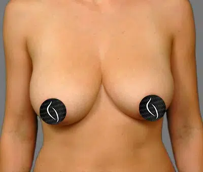 Breast Lift before photo – Mia Aesthetics