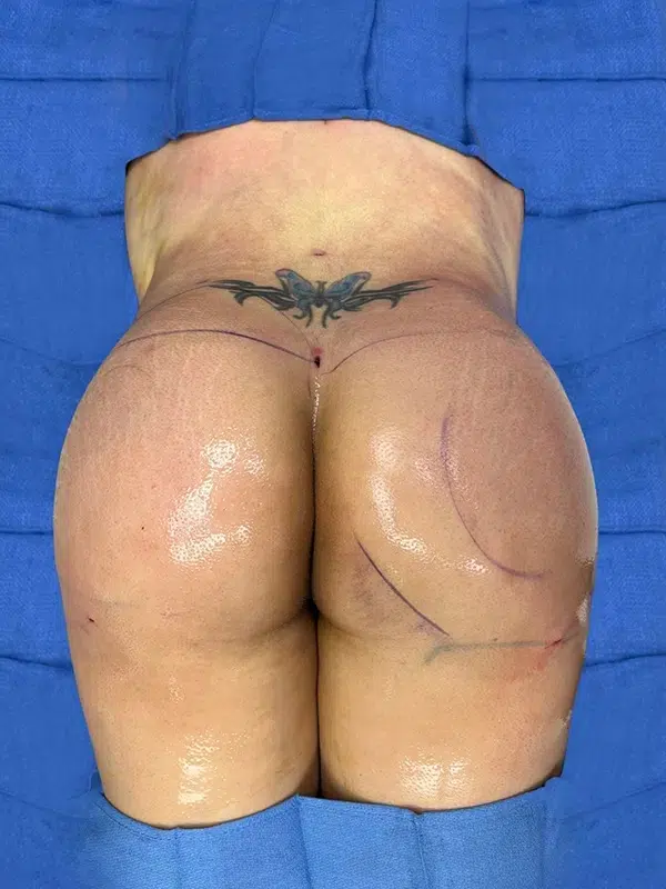 Before & After Result of a Brazilian Butt Lift (BBL)