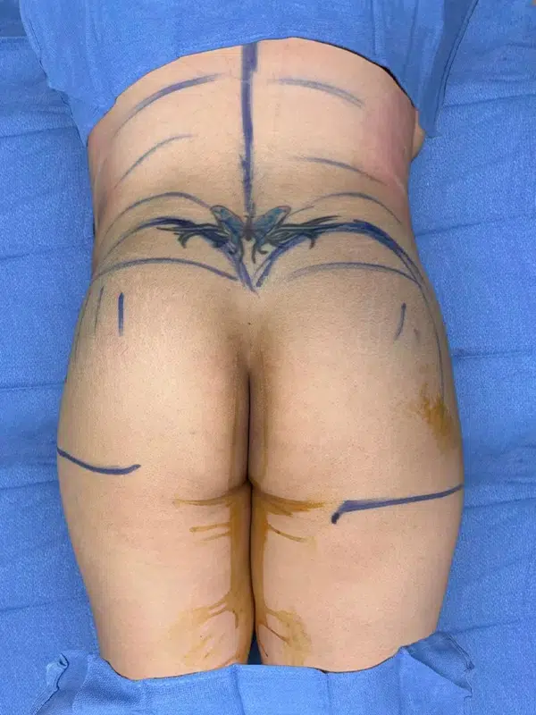Before & After Result of a Brazilian Butt Lift (BBL)