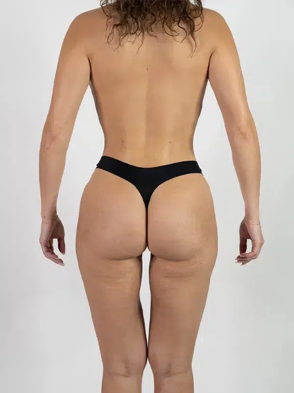 Skinny BBL after photo – Mia Aesthetics
