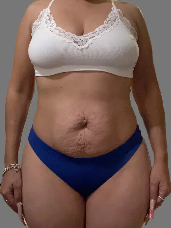 Mommy Makeover before photo – Mia Aesthetics