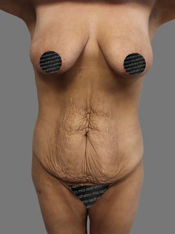 Before Treatment – Case 5004