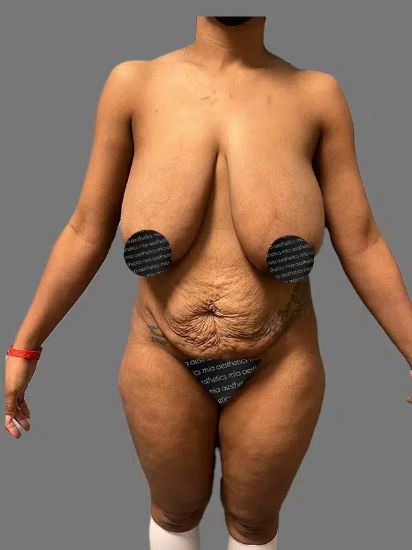 Mommy Makeover before photo – Mia Aesthetics