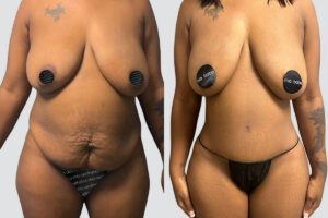 Case 4018 – Tummy Tuck