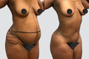 Case 4013 – Tummy Tuck