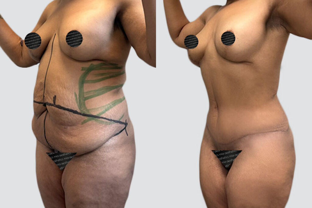 Case 4015 – Tummy Tuck