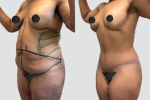 Case 4015 – Tummy Tuck