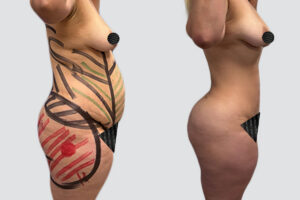 Case 1007 – Lipo 360