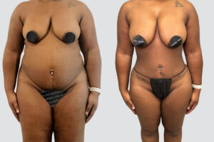 Case 1008 – Lipo 360