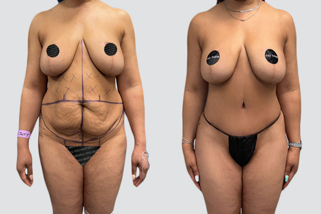 Case 4014 – Tummy Tuck