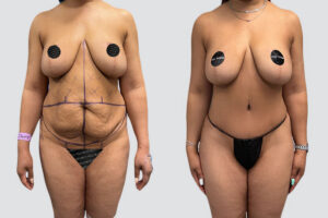 Case 4014 – Tummy Tuck