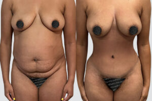 Case 4016 – Tummy Tuck