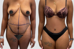 Case 4017 – Tummy Tuck