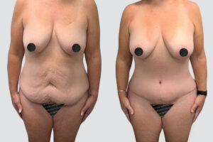 Case 4007 – Tummy Tuck