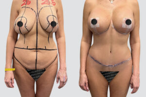 Case 5009 – Mommy Makeover