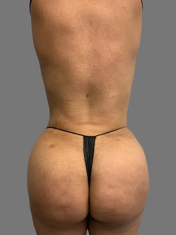 After Treatment – Case 1003