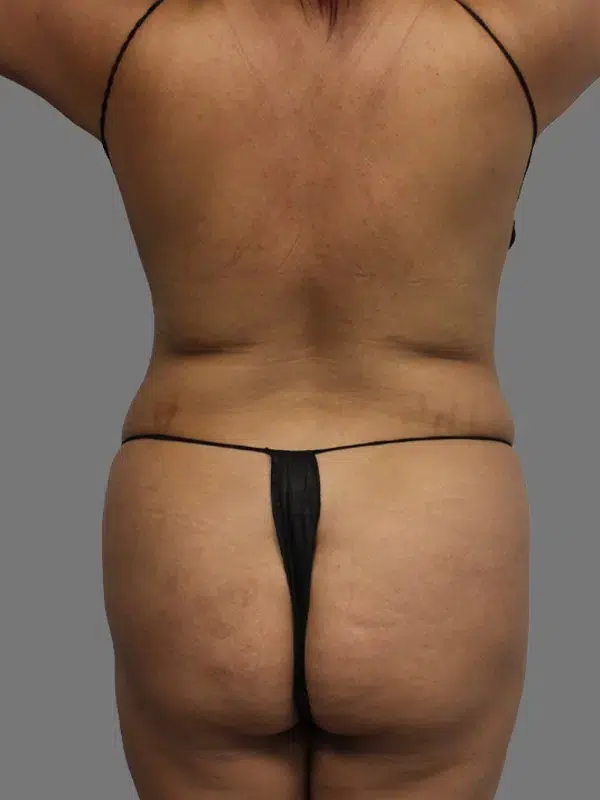 Lipo 360 before photo – Mia Aesthetics