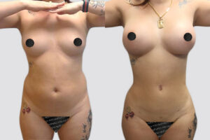 Case 5007 – Mommy Makeover