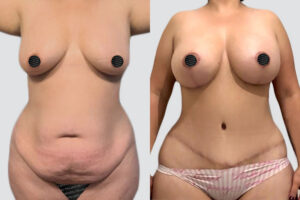 Case 5008 – Mommy Makeover