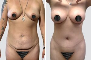 Case 5011 – Mommy Makeover