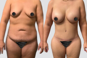 Case 5010 – Mommy Makeover