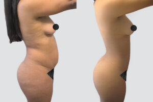 Case 1006 – Lipo 360