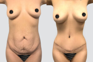 Case 4011 – Tummy Tuck