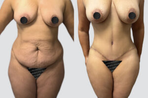 Case 4012 – Tummy Tuck