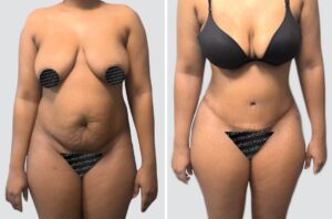 Case 4019 – Tummy Tuck