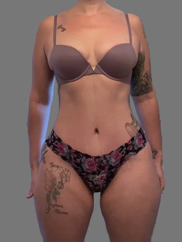 After Treatment – Case 4003