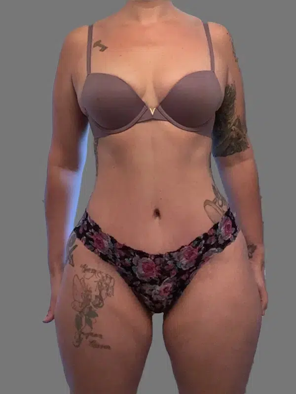 Tummy Tuck after photo – Mia Aesthetics