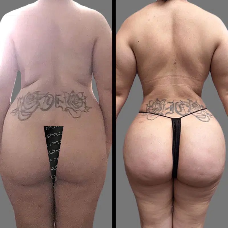 Dr. Bronstein • Brazilian Butt Lift (BBL) • image 1