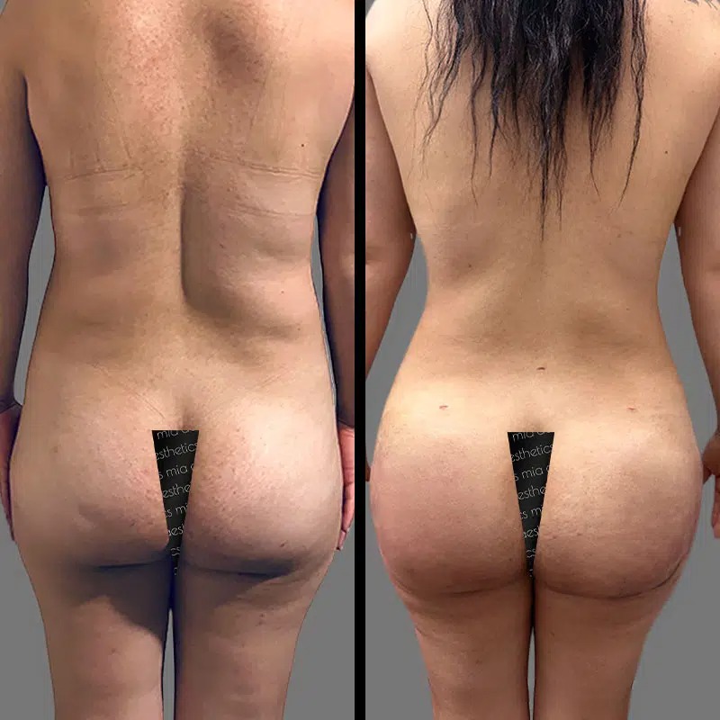 Dr. Bronstein • Brazilian Butt Lift (BBL) • image 4