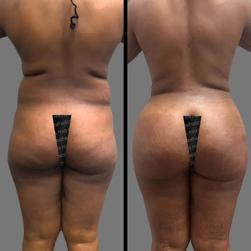 Dr. Bronstein • Brazilian Butt Lift (BBL) • image 5