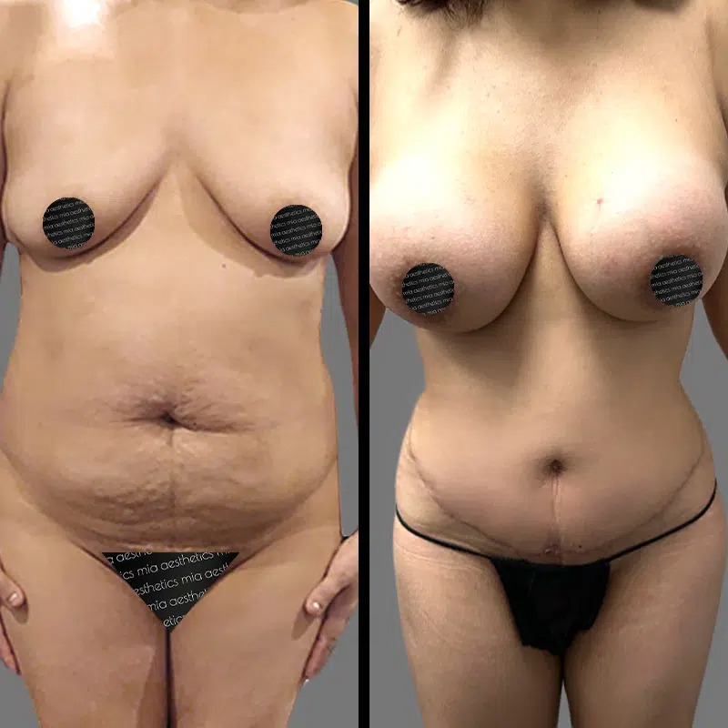 Dr. Bronstein • Mommy Makeover • image 1