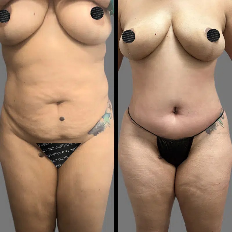 Dr. Bronstein • Tummy Tuck • image 2