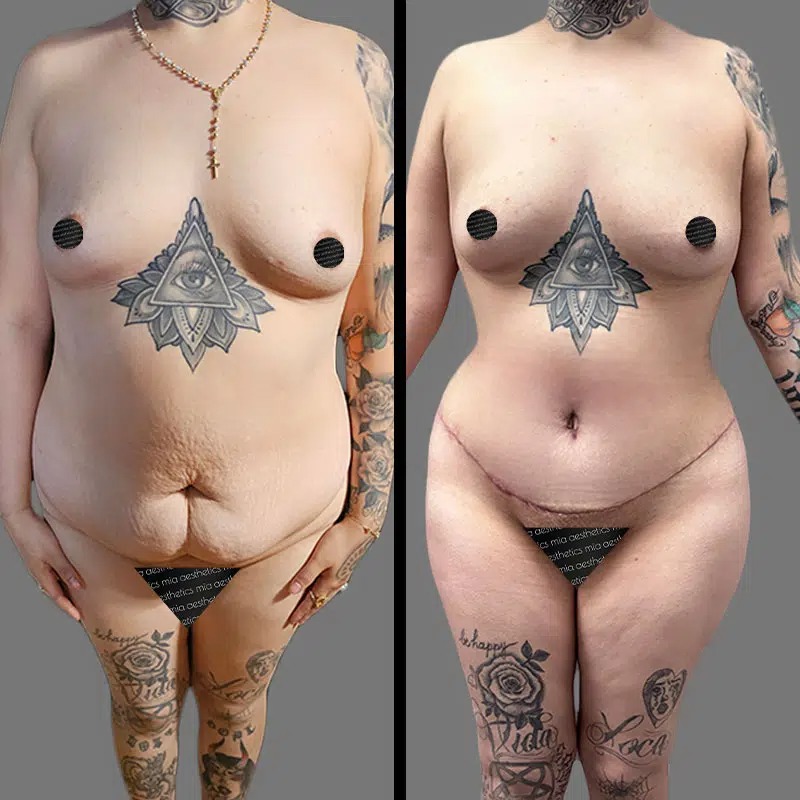 Dr. Bronstein • Tummy Tuck • image 3