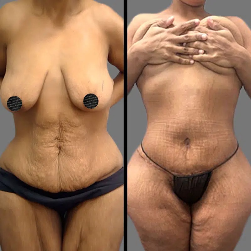 Dr. Bronstein • Tummy Tuck • image 4