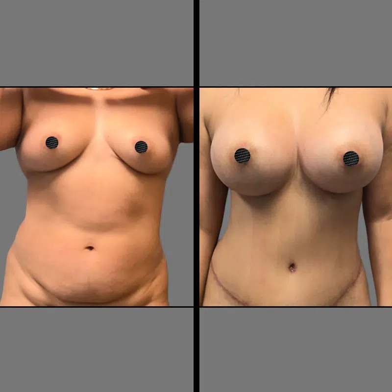 Dr. Charepoo • Breast Procedures • image 3