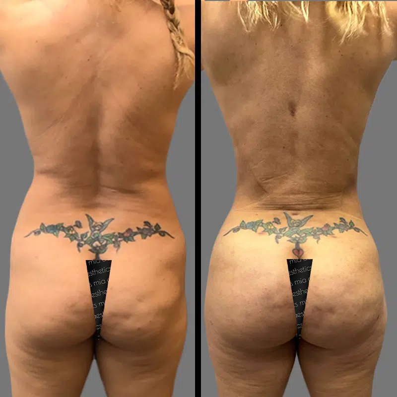Dr. Charepoo • Brazilian Butt Lift (BBL) • image 2