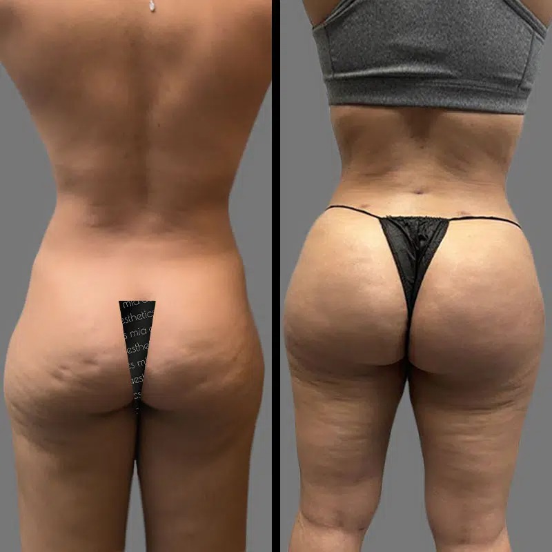 Dr. Charepoo • Brazilian Butt Lift (BBL) • image 3