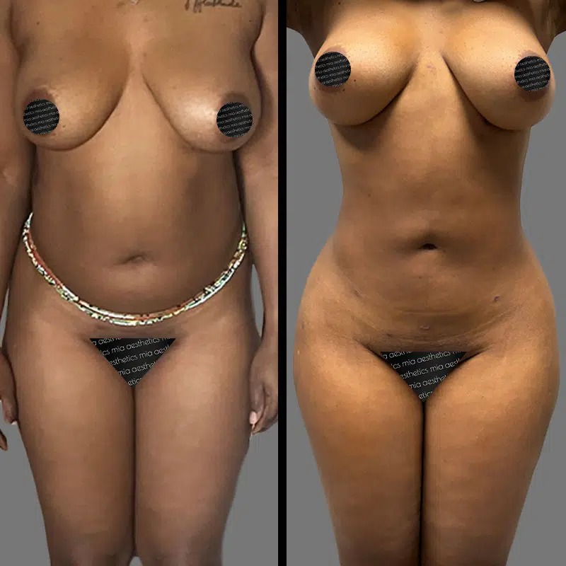 Dr. Charepoo • Lipo 360 • image 2