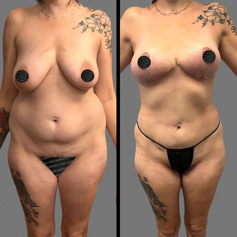 Dr. Charepoo • Lipo 360 • image 3