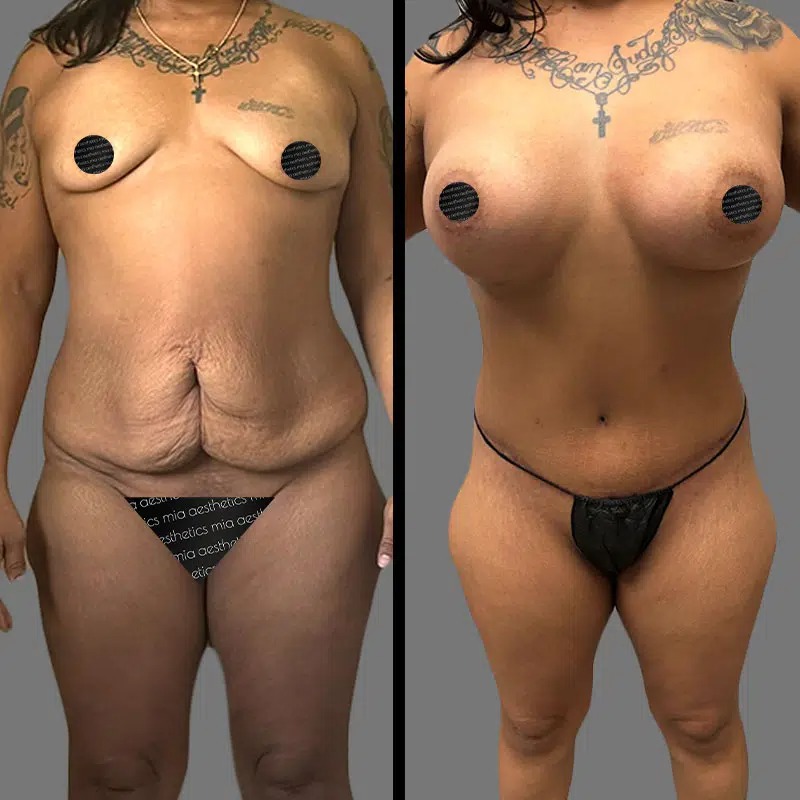 Dr. Charepoo • Mommy Makeover • image 2