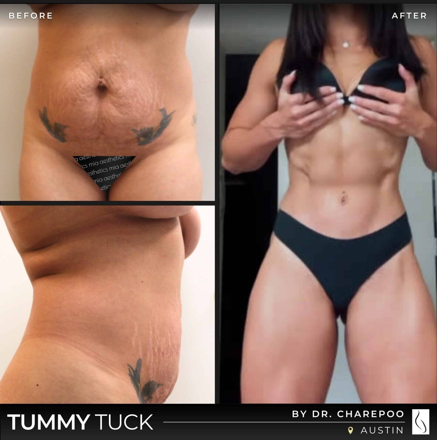 Dr. Charepoo • Tummy Tuck • image 4