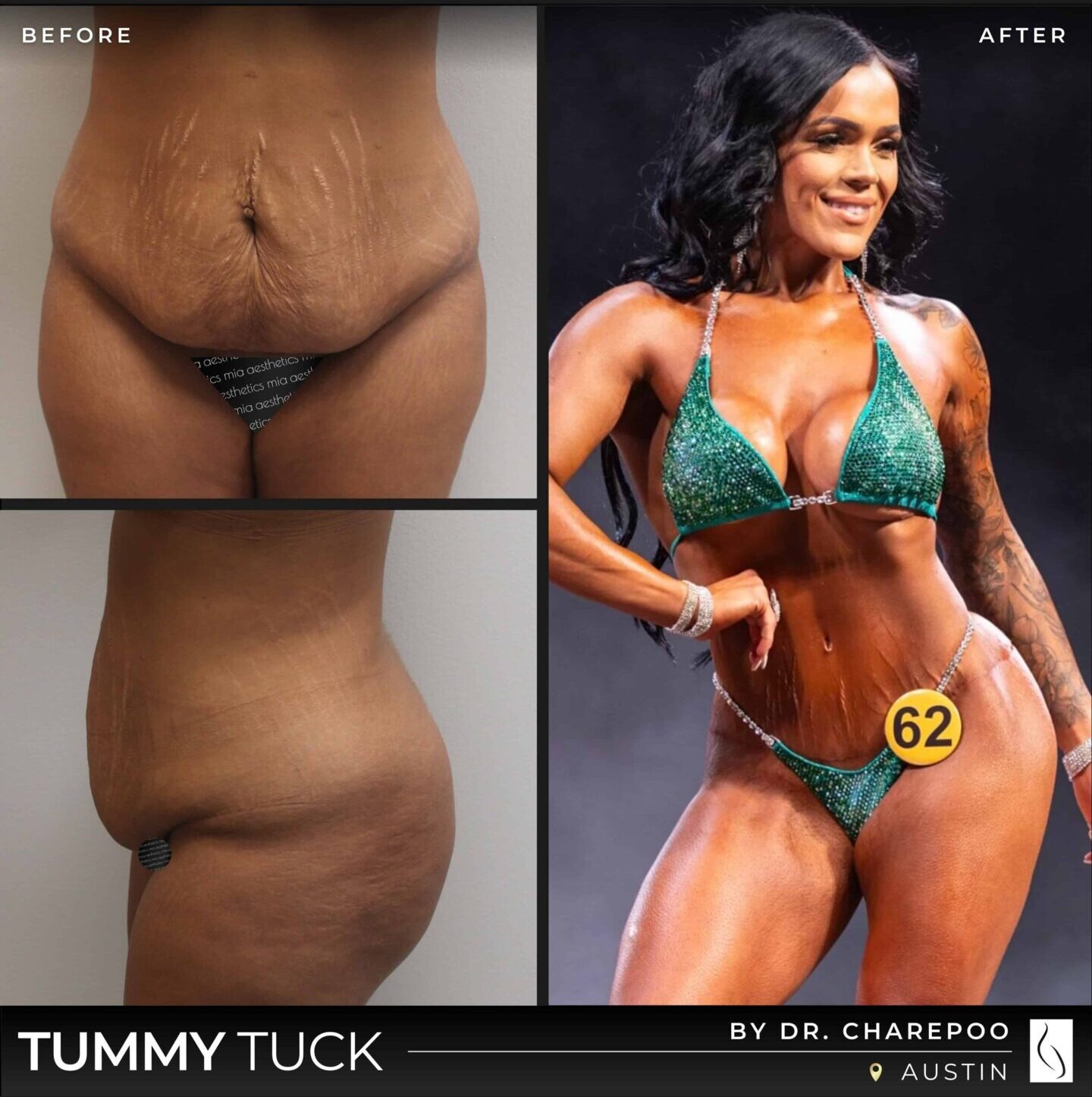 Dr. Charepoo • Tummy Tuck • image 2