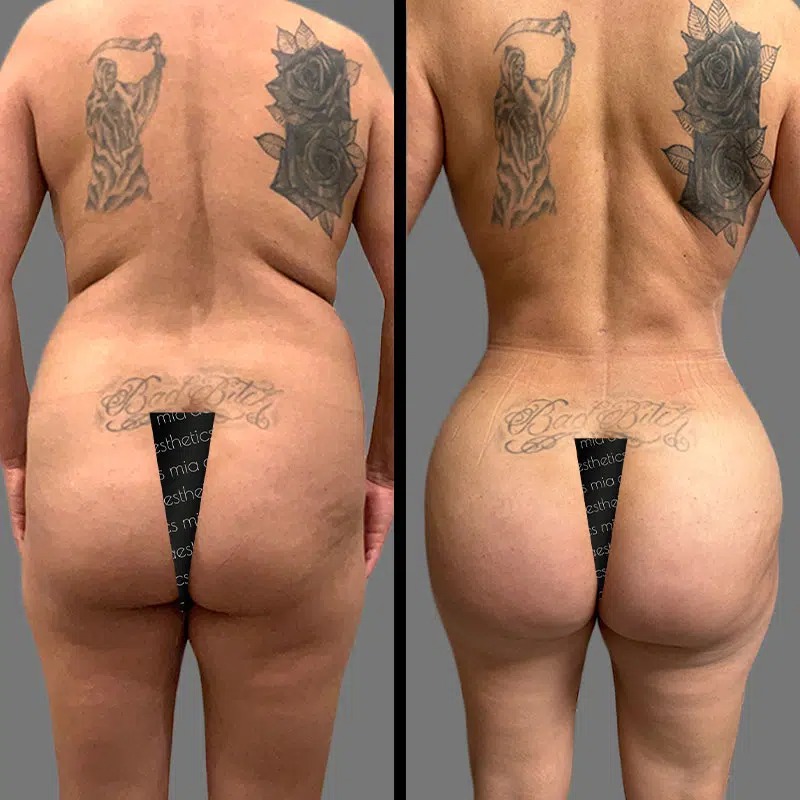 Dr. Cooper • Brazilian Butt Lift (BBL) • image 1