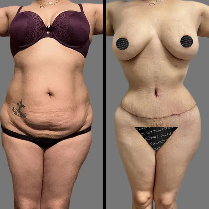 Dr. Cooper • Tummy Tuck • image 2
