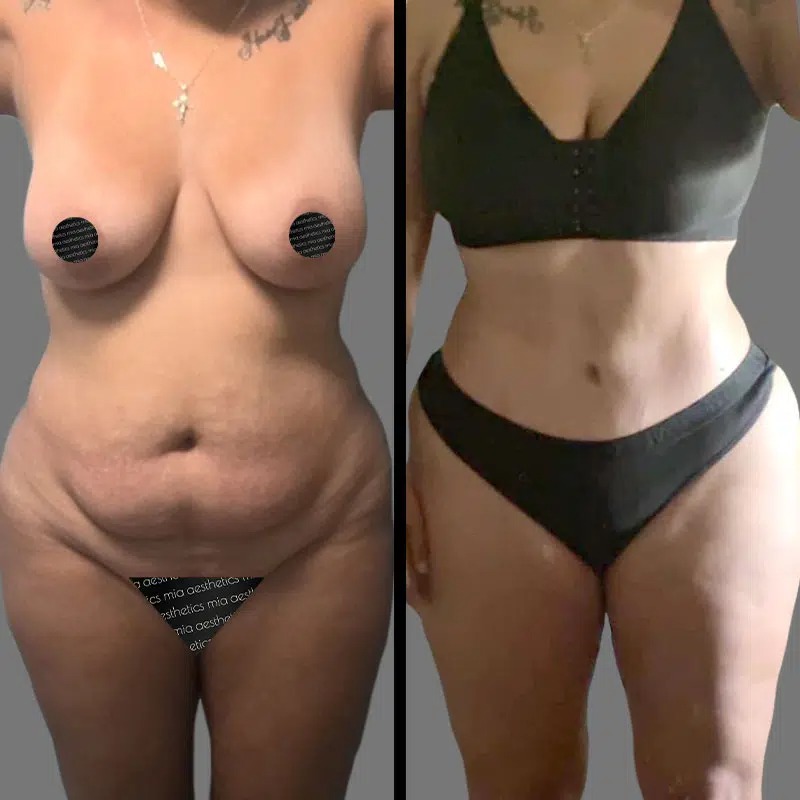 Dr. Cooper • Tummy Tuck • image 3