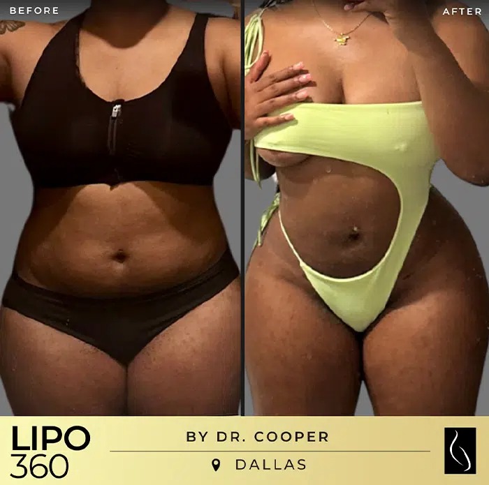 Dr. Cooper • Lipo 360 • image 2
